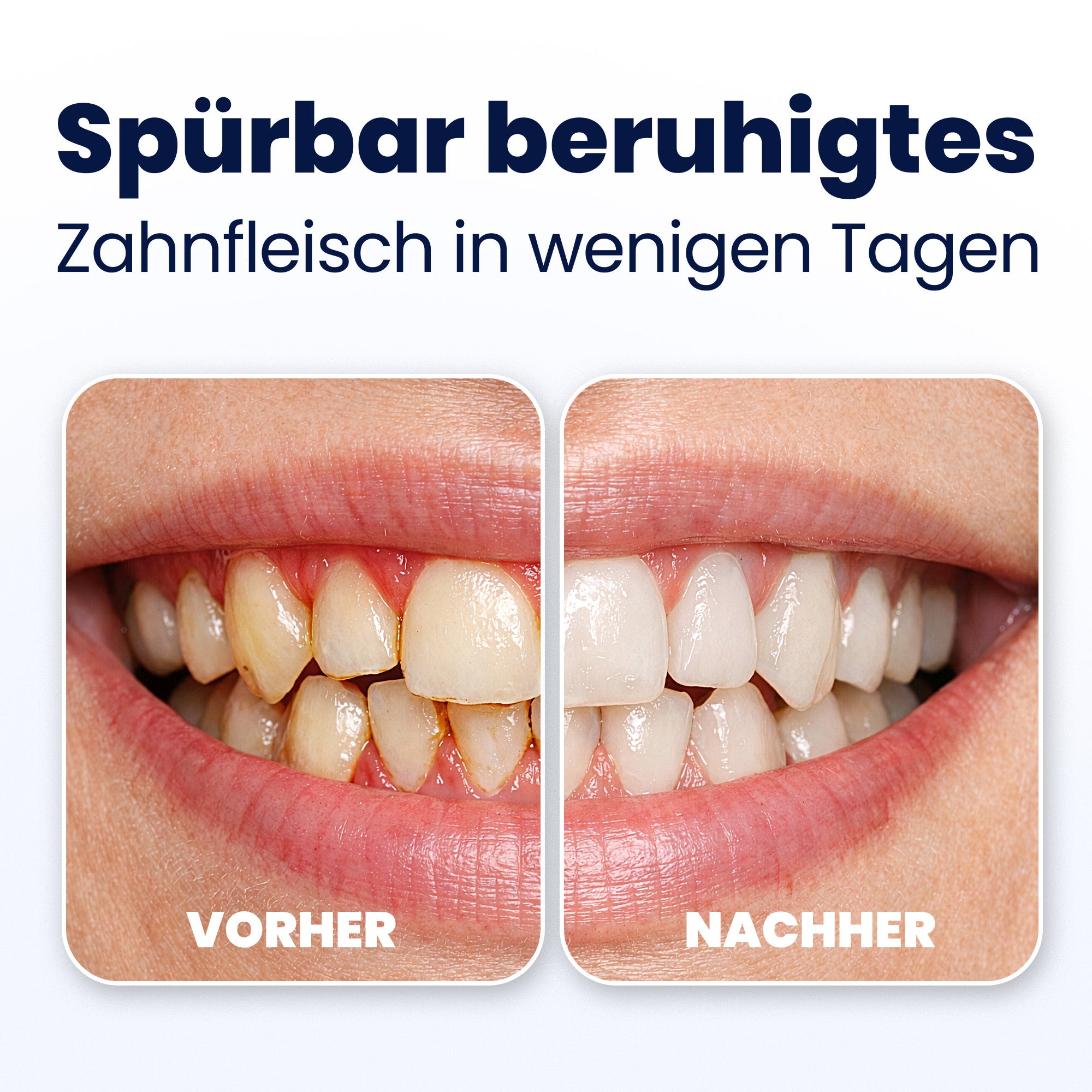 Before and after comparison of dental treatment showing healthier gums.