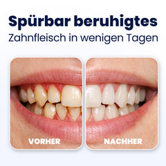 Before and after comparison of dental treatment showing healthier gums.