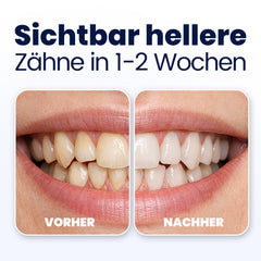 Before and after comparison of teeth with visible text indicating improved tooth appearance.
