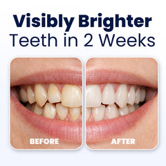 Before and after showing visibly brighter teeth in 2 weeks with a mouth close-up.